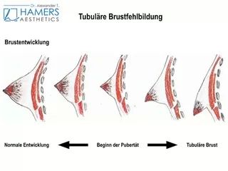 tubuläre Brust