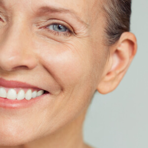Facelift